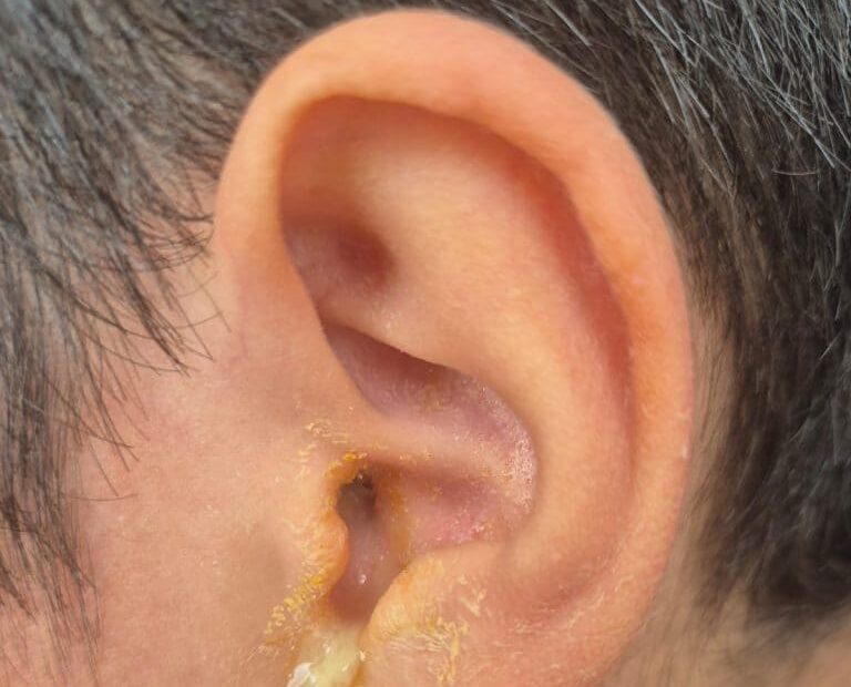 Criança tem tímpano perfurado após ser agredida por um oficial de justiça em condomínio na zona Centro-Sul de Manaus 