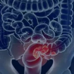 Pacientes com câncer colorretal são diagnosticados em estágio avançado