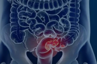 Pacientes com câncer colorretal são diagnosticados em estágio avançado