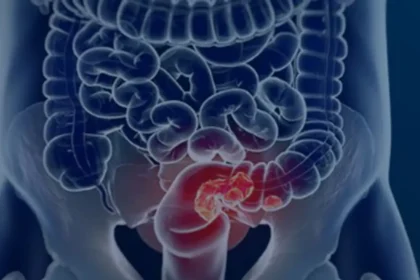 Pacientes com câncer colorretal são diagnosticados em estágio avançado