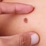 A importância da prevenção do câncer de pele e orientações sobre sintomas e cuidados