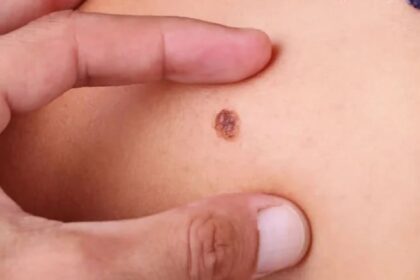 A importância da prevenção do câncer de pele e orientações sobre sintomas e cuidados