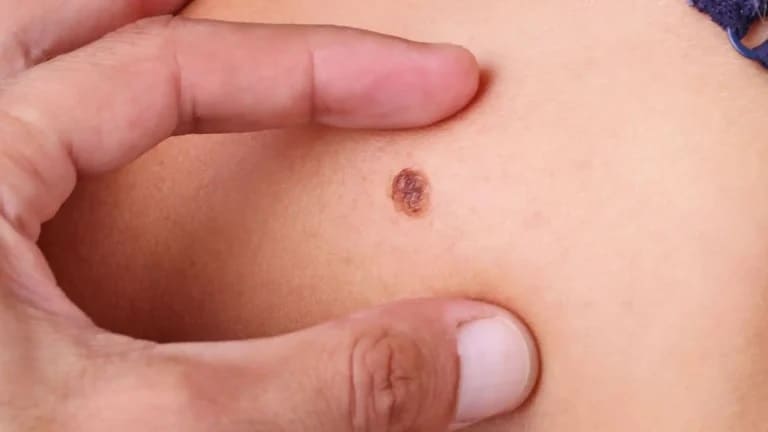 A importância da prevenção do câncer de pele e orientações sobre sintomas e cuidados